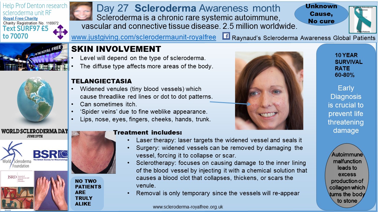 What is the 5-year survival rate for scleroderma?